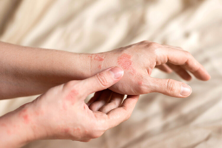 Skin Problem