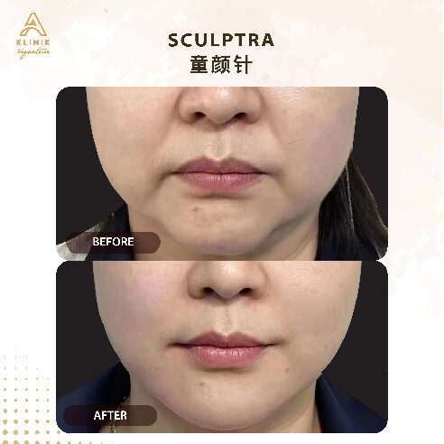 20250723_AKS_Sculptra Website-15