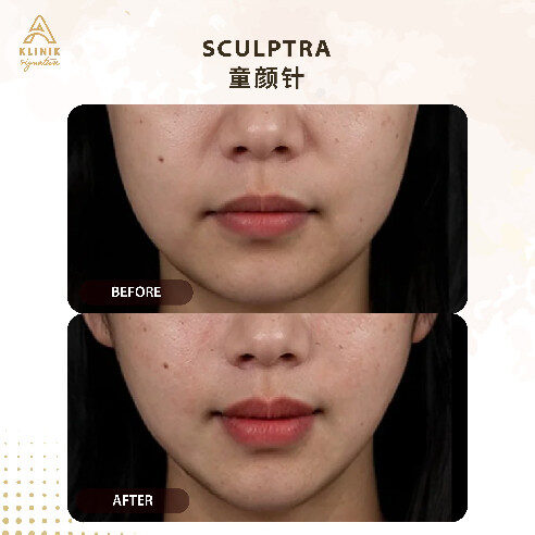 20250723_AKS_Sculptra Website-16