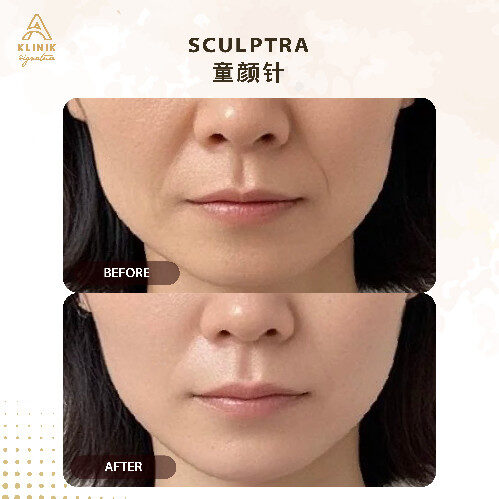 20250723_AKS_Sculptra Website-18