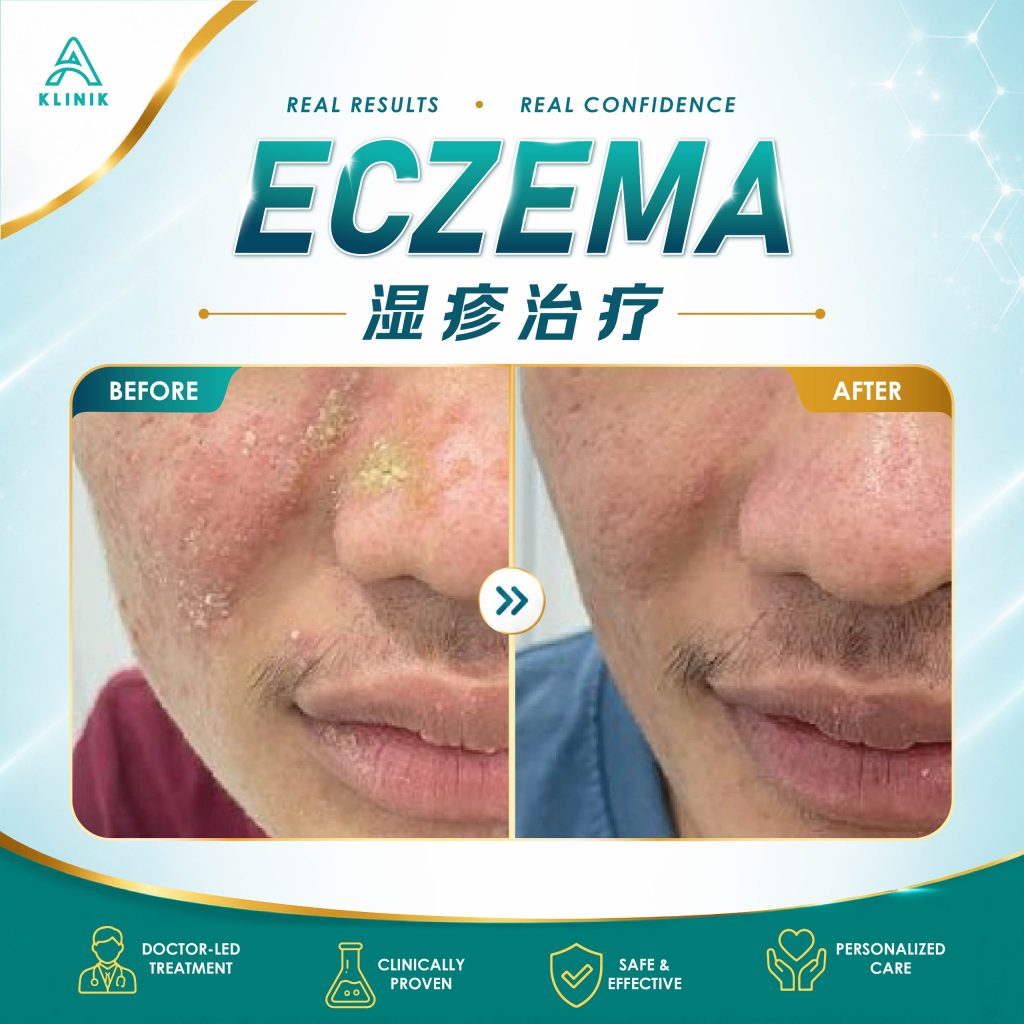 Eczema treatment in Penang, PJ, KL & Selangor at A Klinik Medical