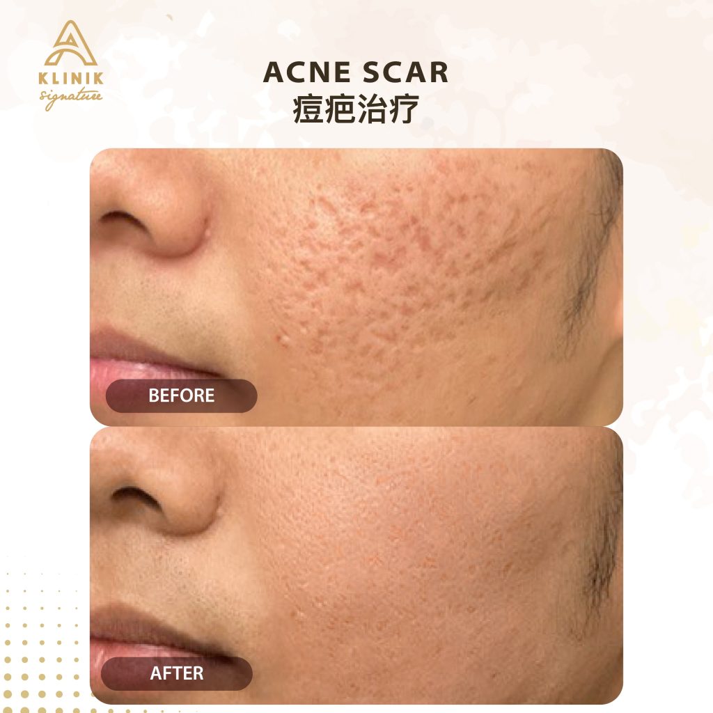 Acne scar treatment in Penang, PJ, KL & Selangor at A Klinik Signature