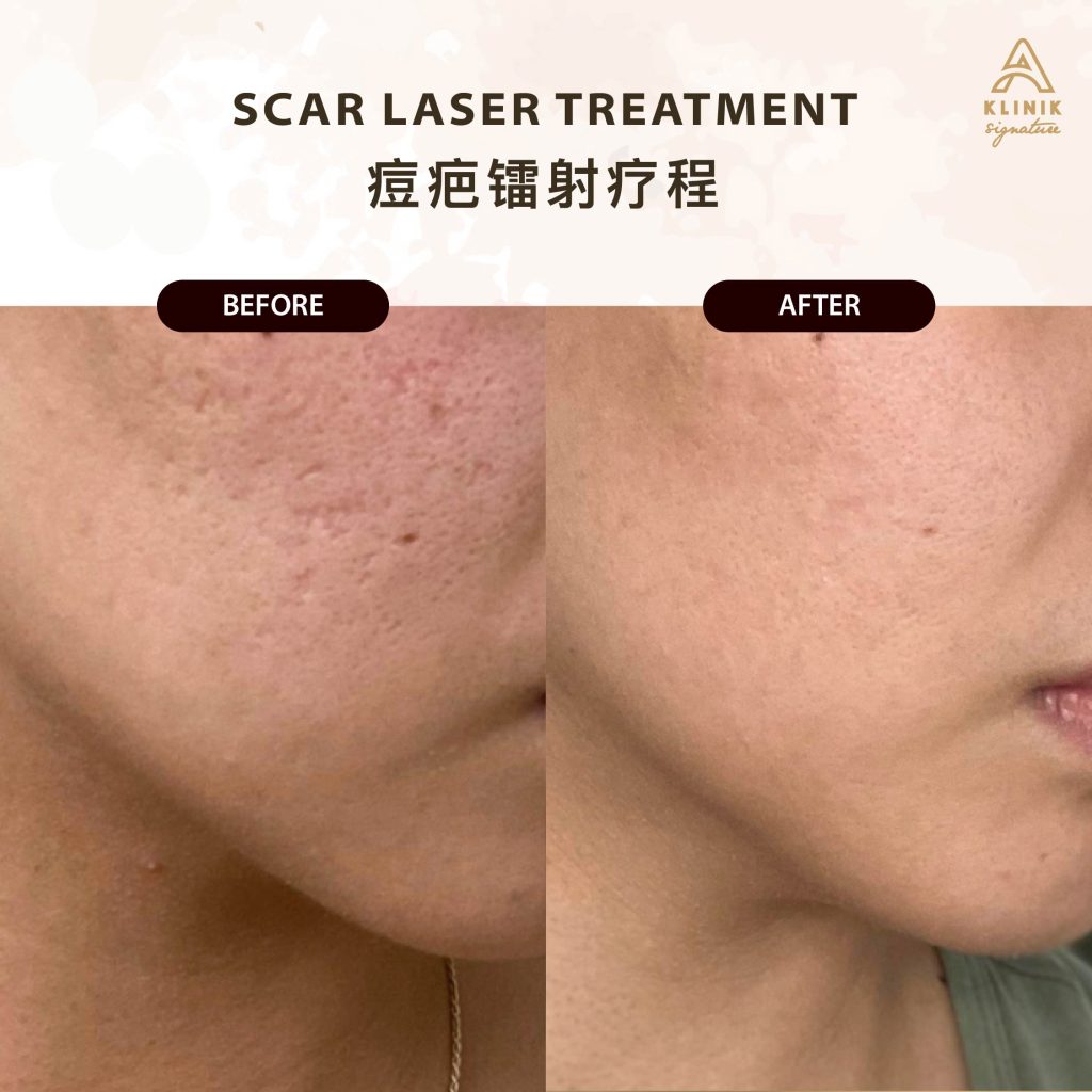 Acne scar treatment in Penang, PJ, KL & Selangor at A Klinik Signature