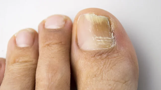 nail fungus